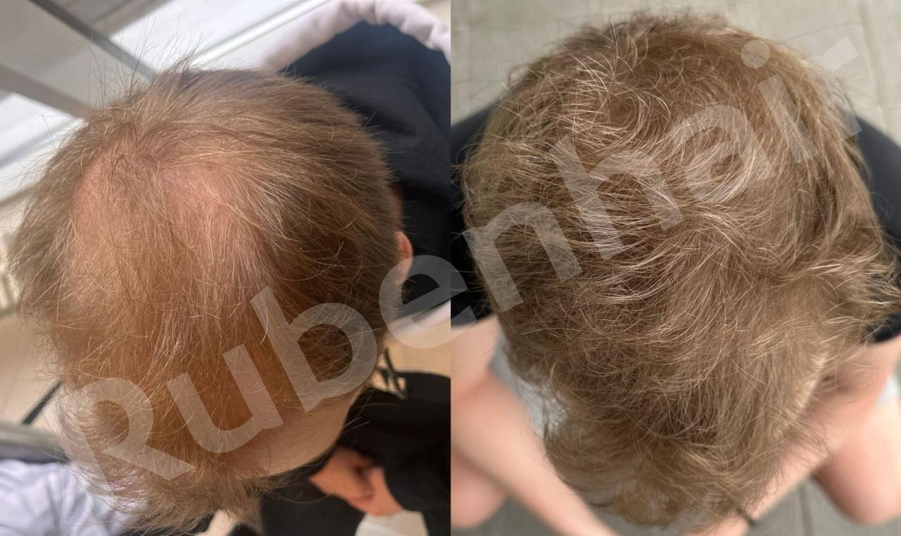 Result after 6 months