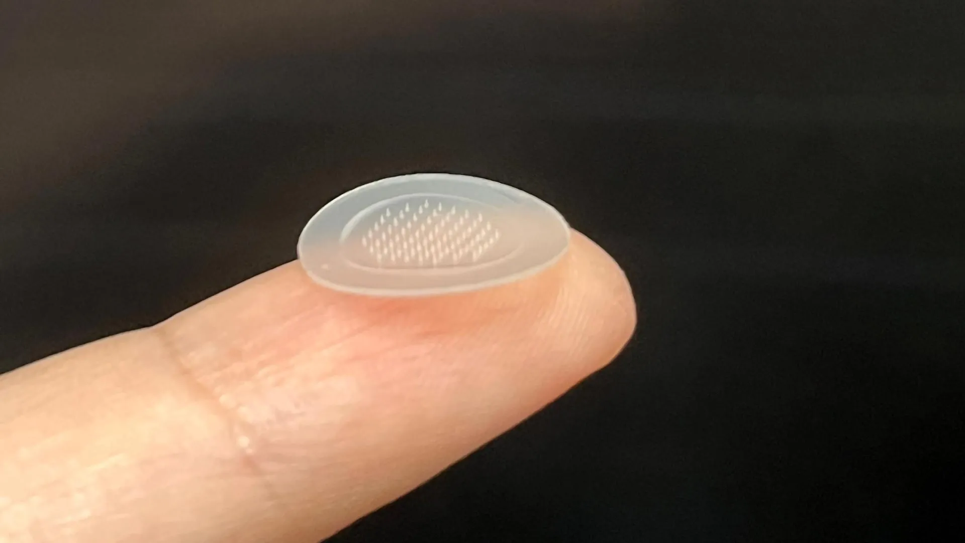 Vienos savaitės skaidriasis odos su šiuo išradimu, priešakiniais aknės dėmelėmis