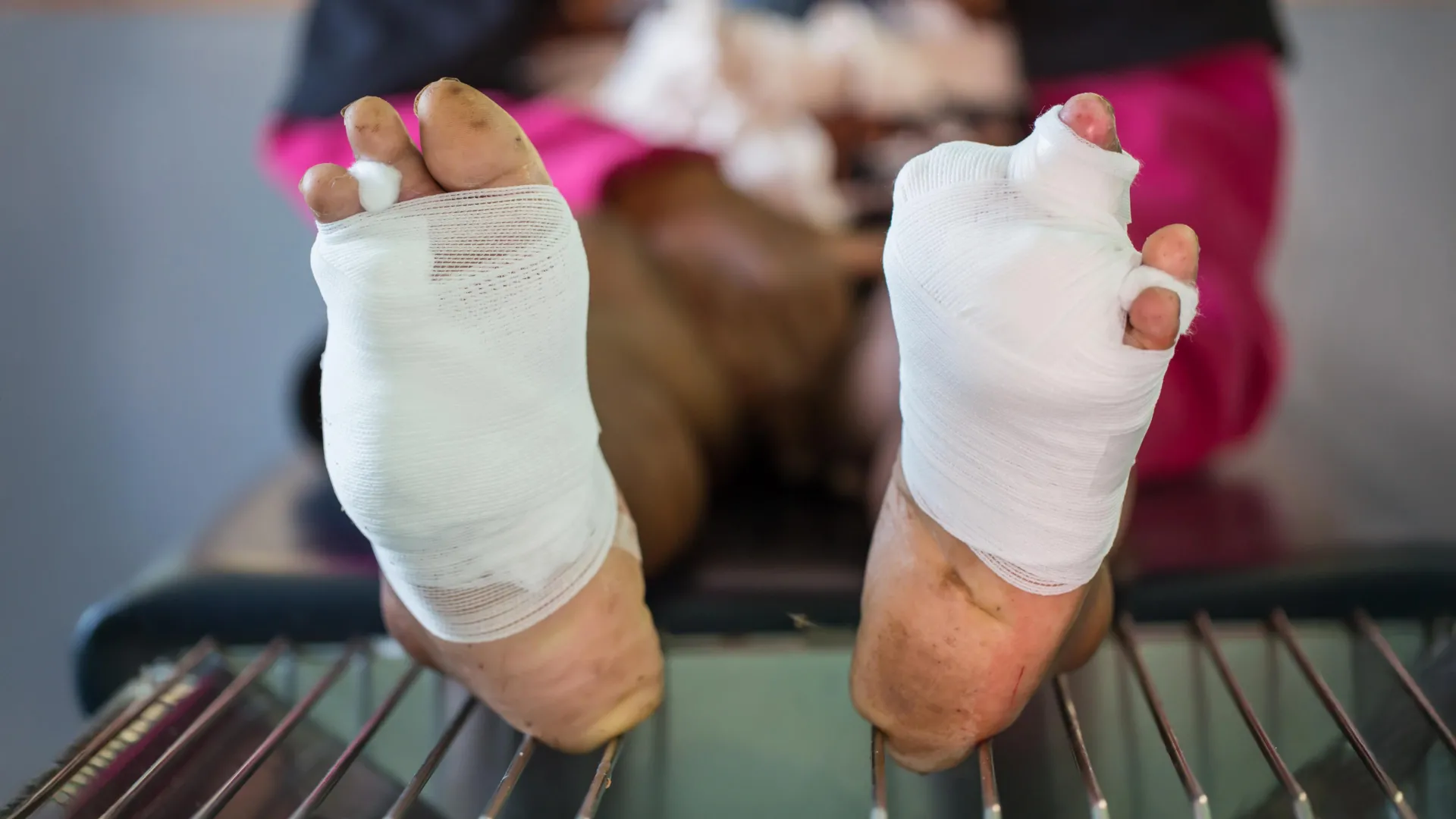 Гель для дыхательной терапии показывает обещания для заживления ран у диабетиков.